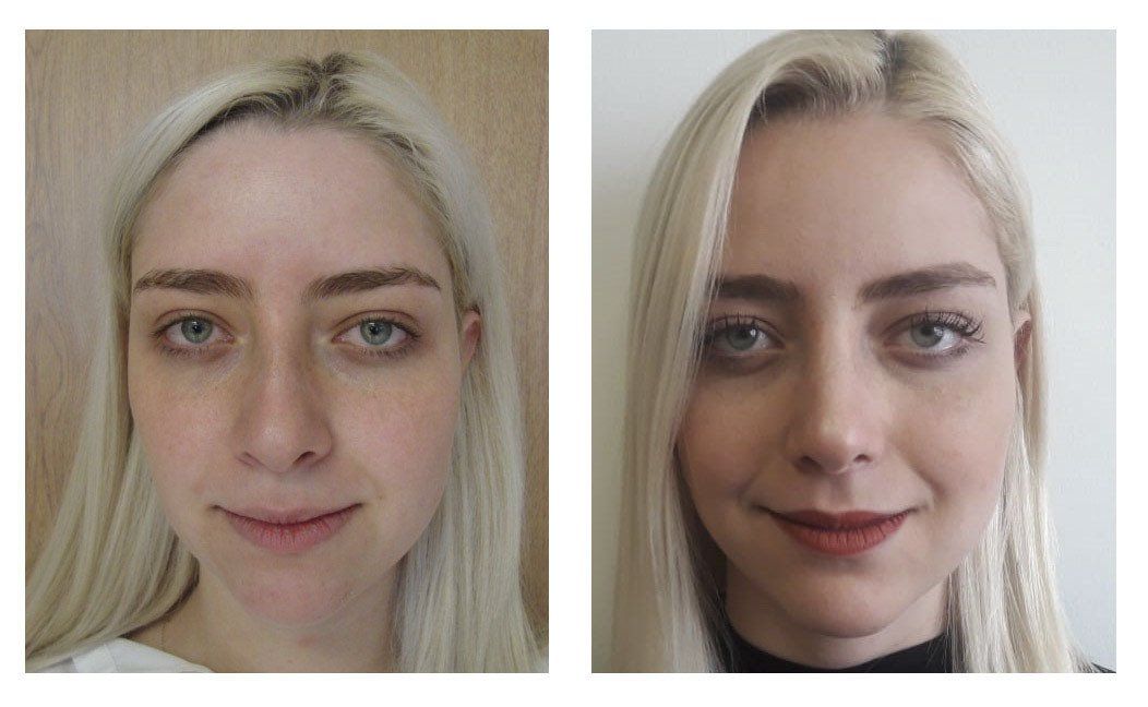 rhinoplasty in mexico