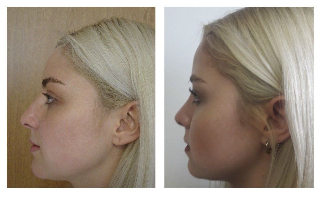 rhinoplasty in mexico