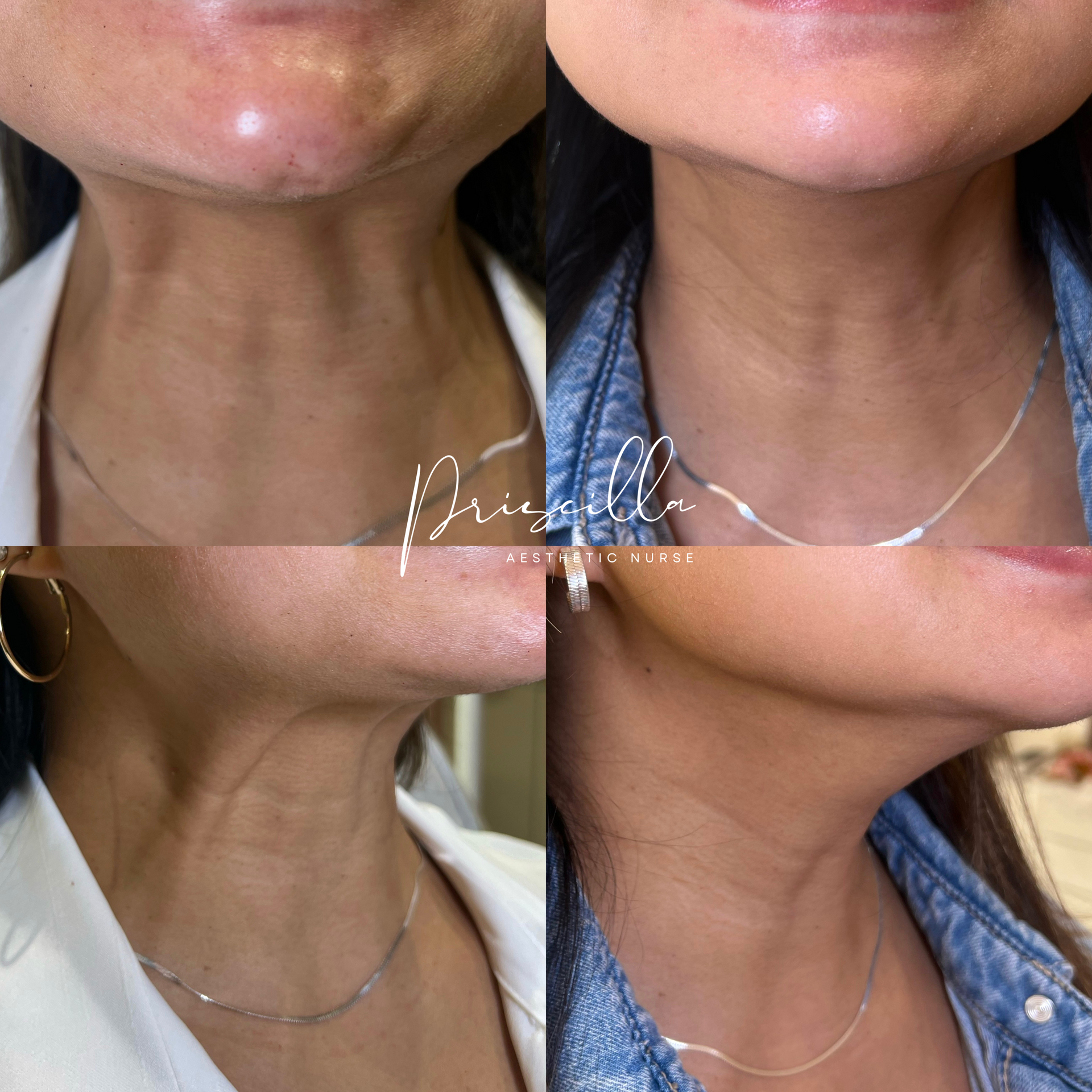 a before and after photo of a woman 's neck and face