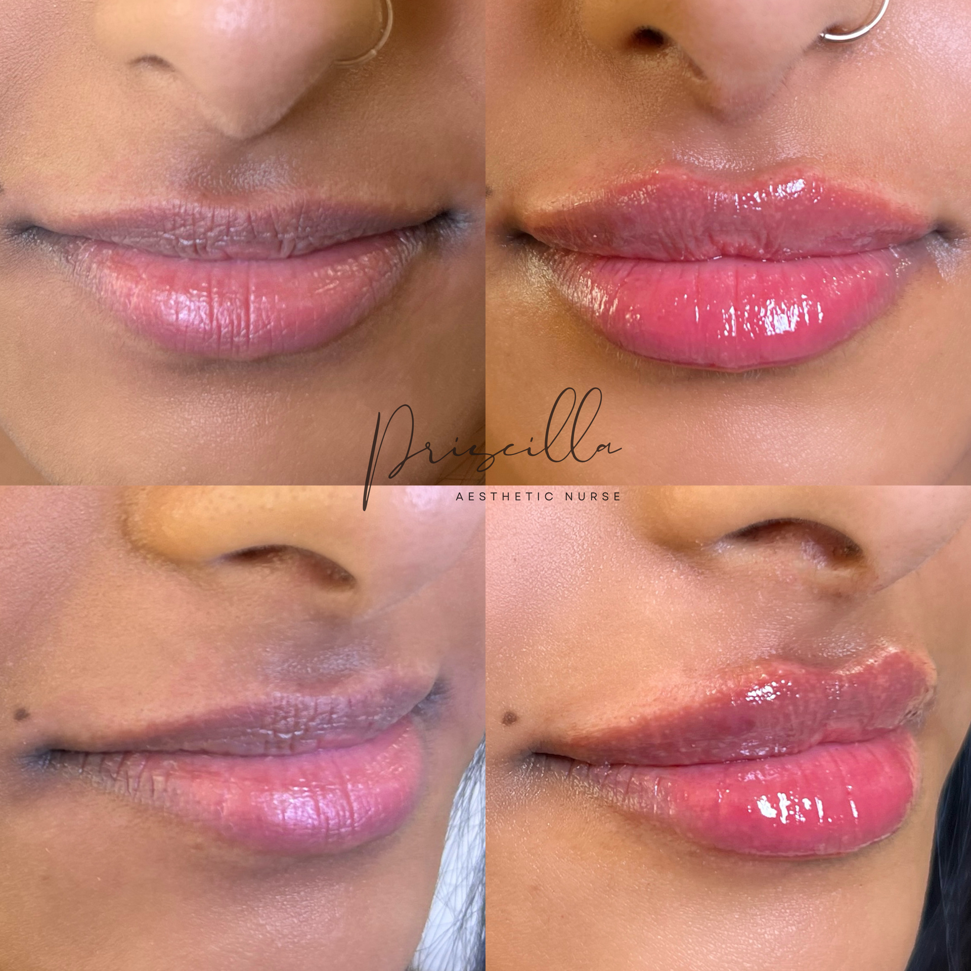 a before and after photo of a woman 's lips .