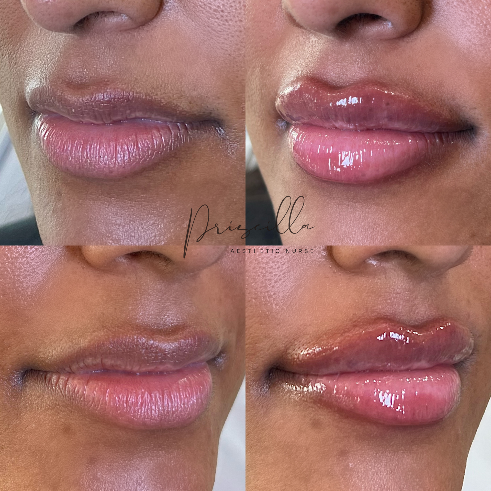 Close-up of a woman's lips before and after lip filler. The enhanced lips are fuller and glossy.