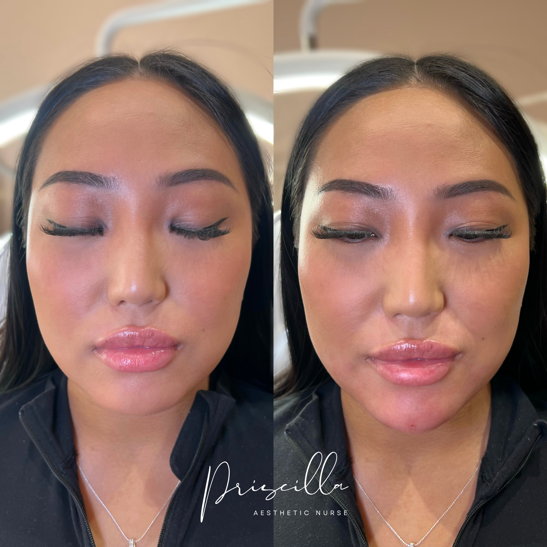 Before and after photos of a woman's face, showing lip and cheek fillers; natural skin tone, closed eyes.