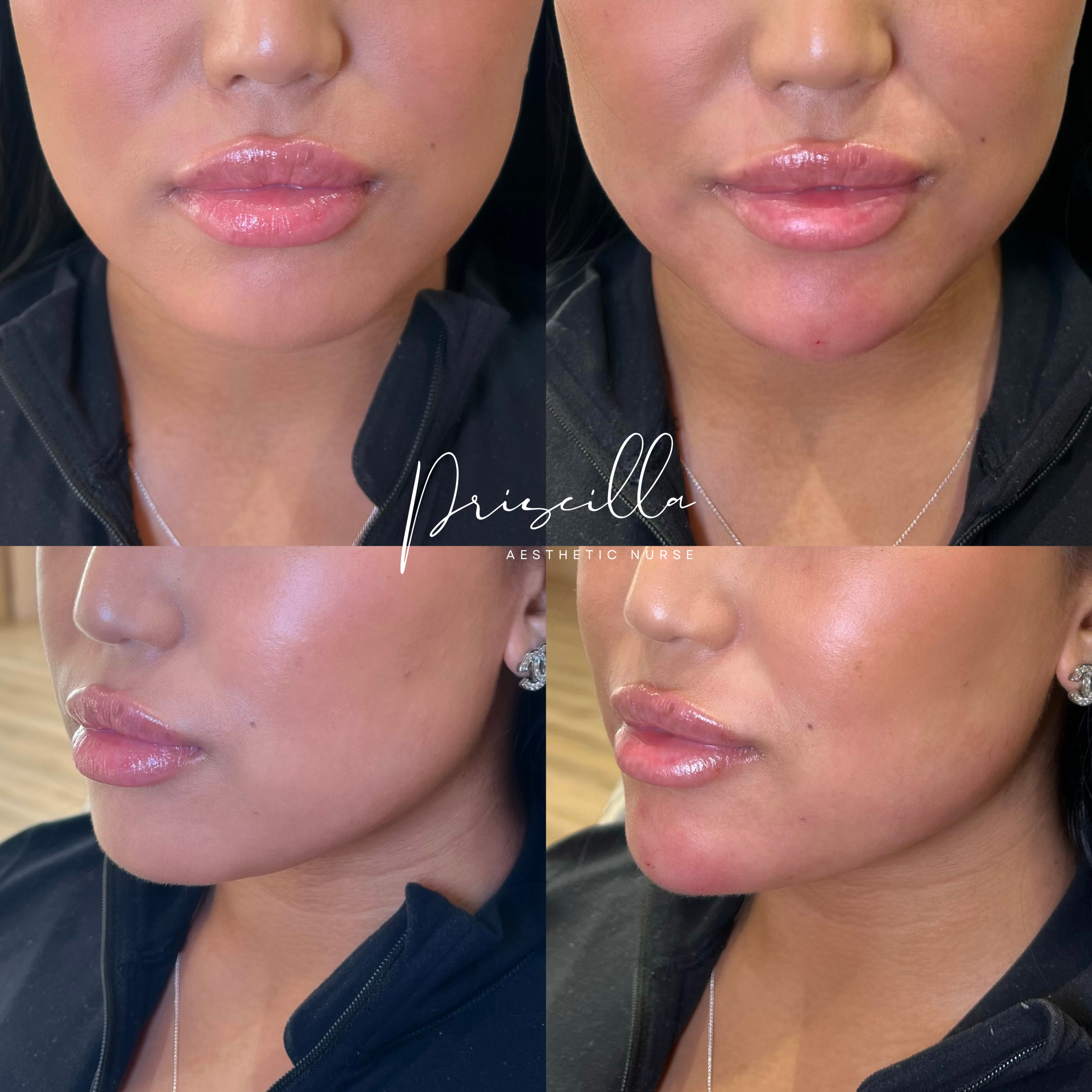 Four-panel photo showing a woman's face before and after cosmetic injections in her lips and chin.
