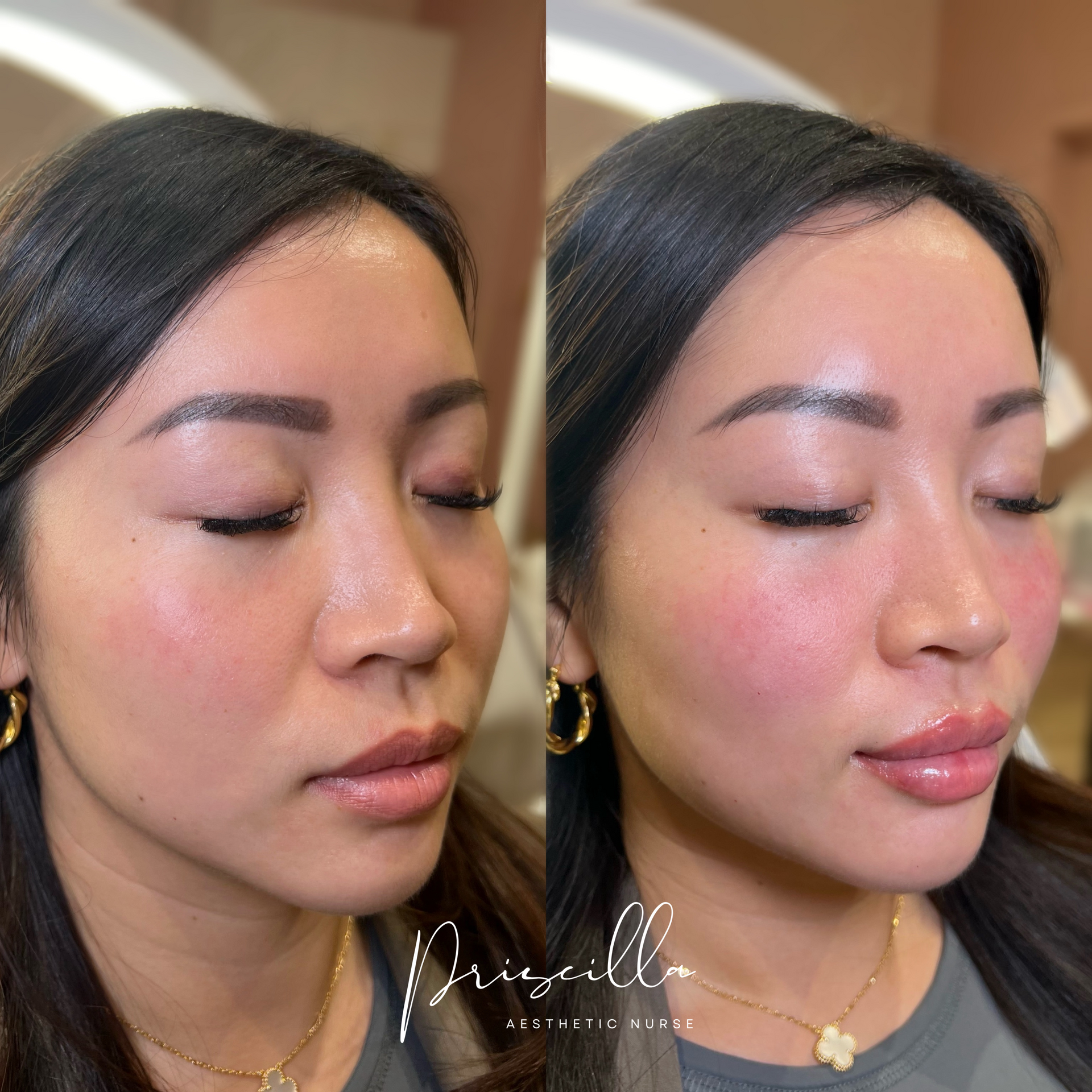 Before and after photos of a woman's face, with enhanced lips and cheeks.