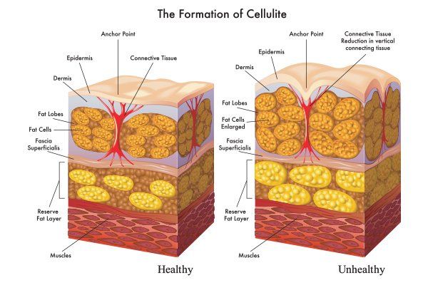How To Get Rid of Cellulite: Treatment & Lifestyle Changes – Dermatology  Associates of Rochester