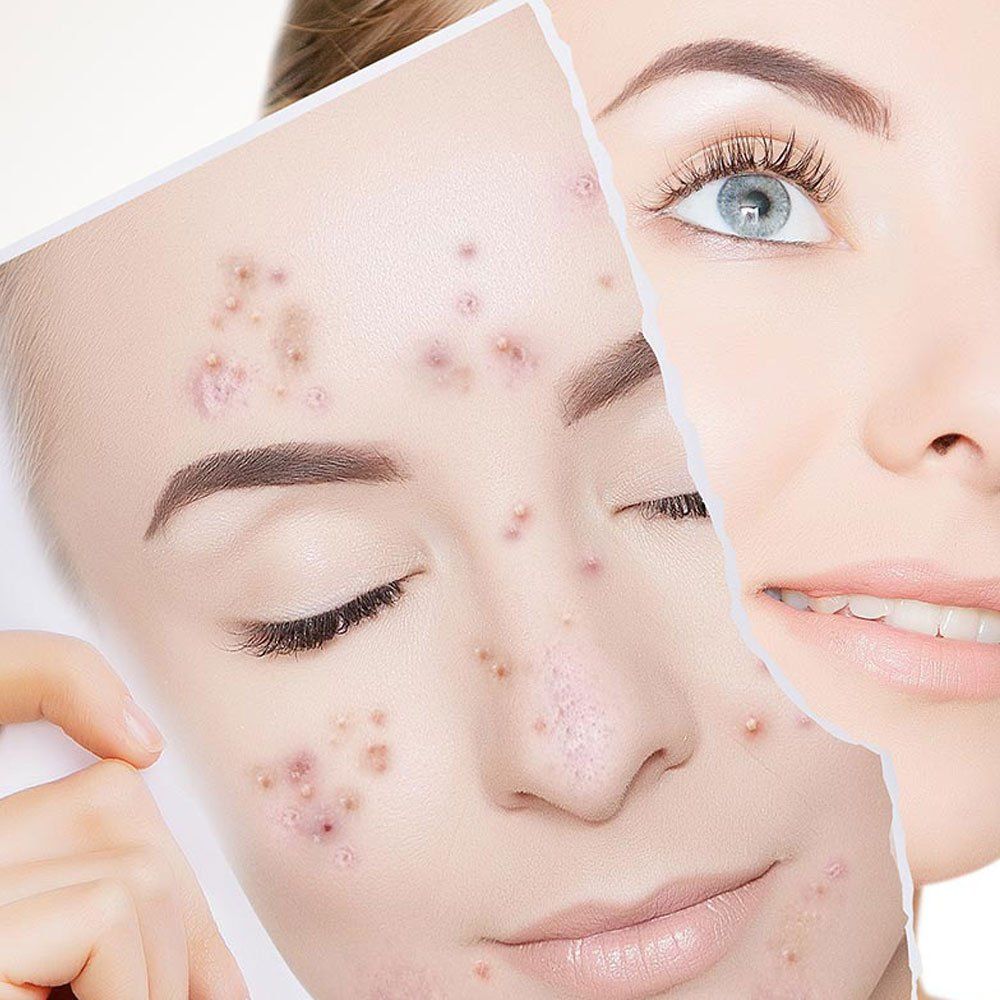 Acne Reduction Rochester NY