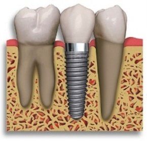 Tooth Implants — Fair Oaks, CA — Sun Oaks Dental
