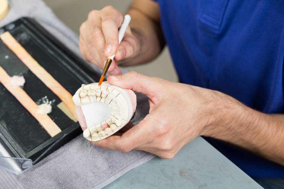 calco arcata dentale per creazione protesi