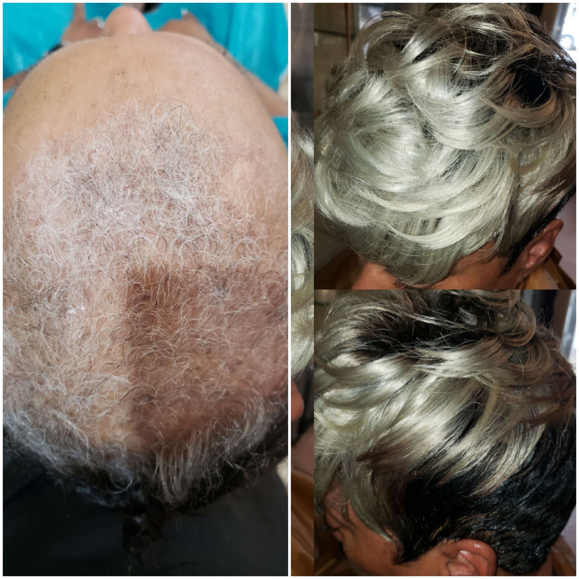 Nonsurgical Hair Replacement