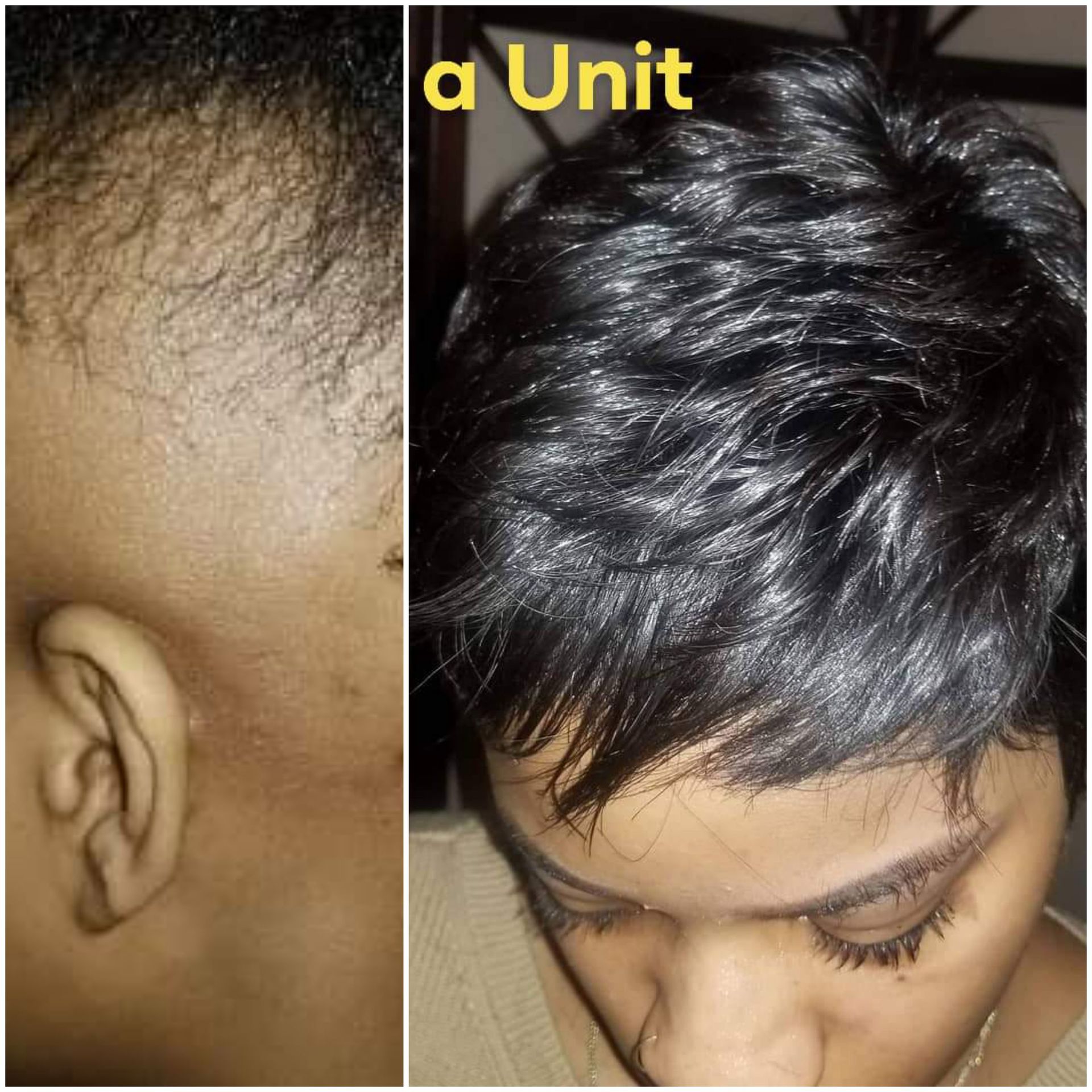 Nonsurgical Hair Replacement