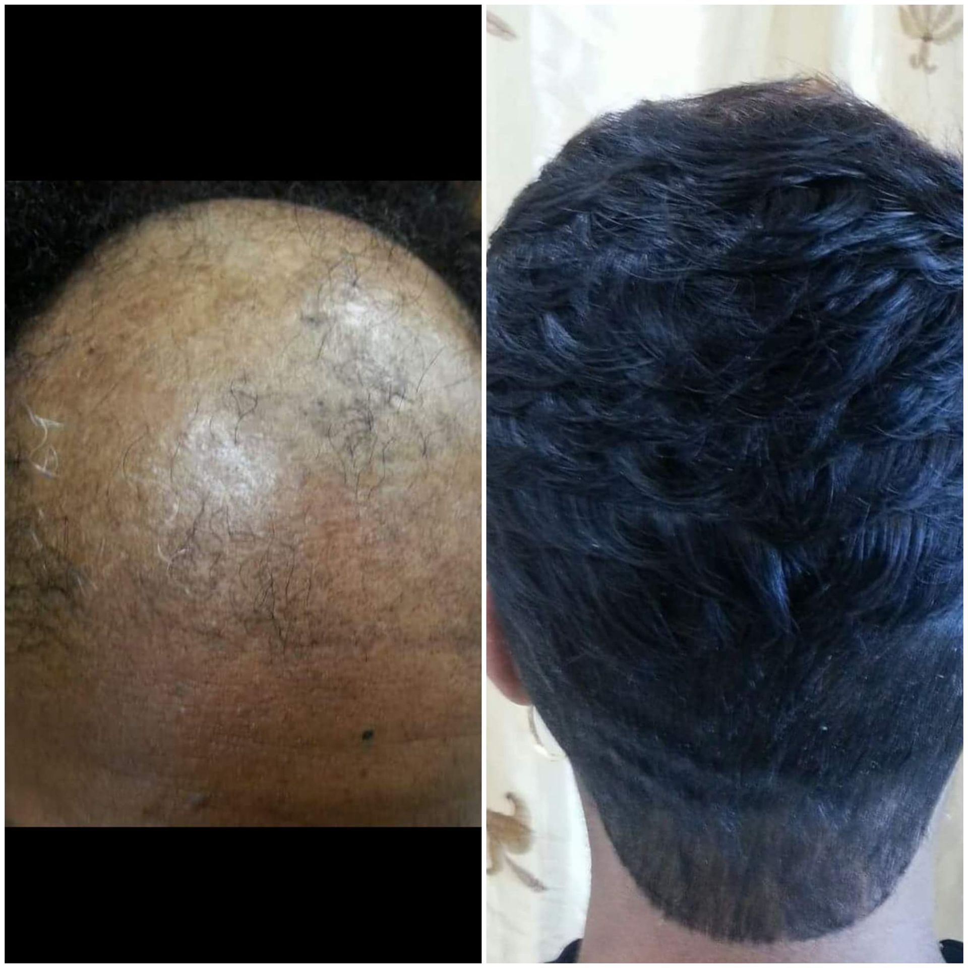 Nonsurgical Hair Replacement
