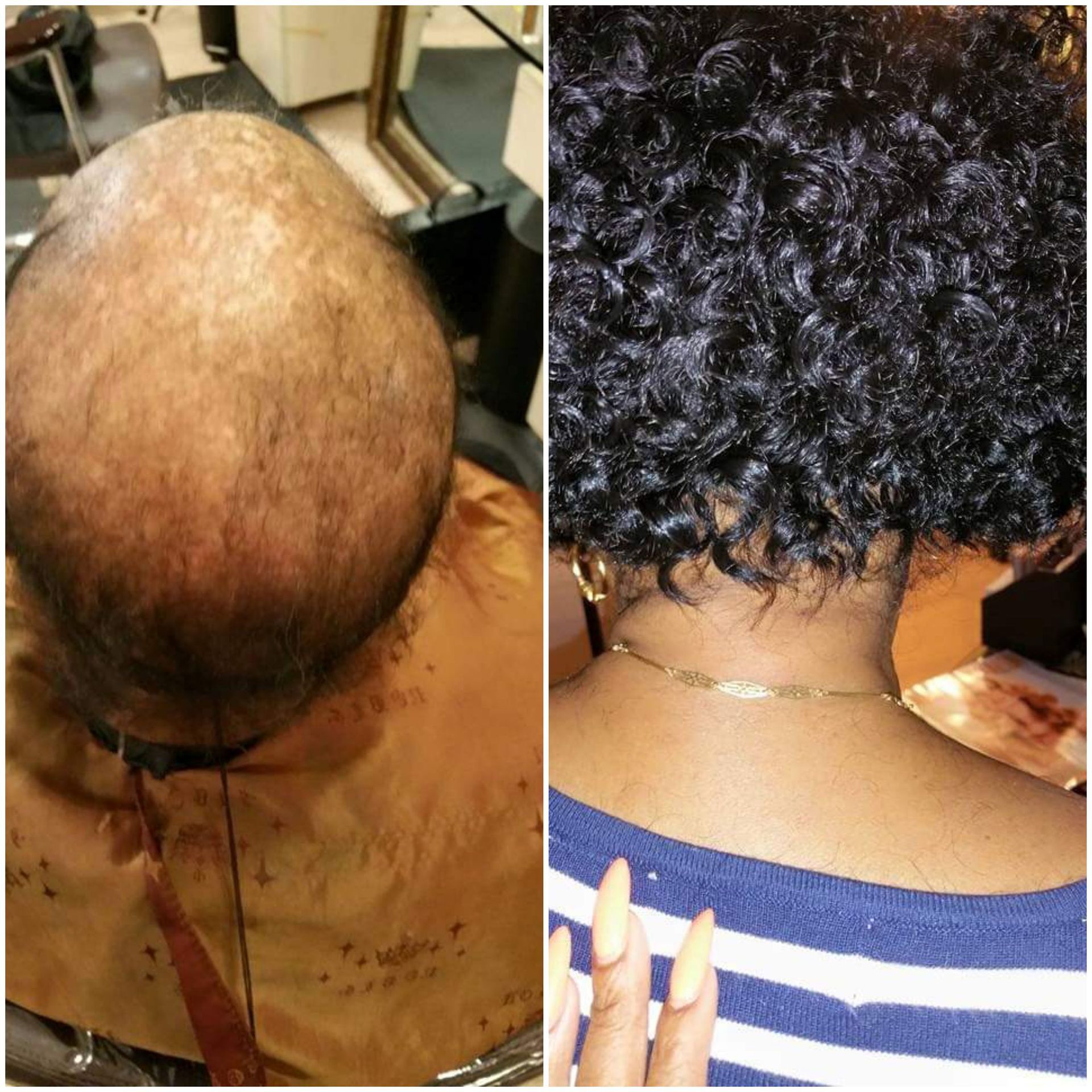 Nonsurgical Hair Replacement