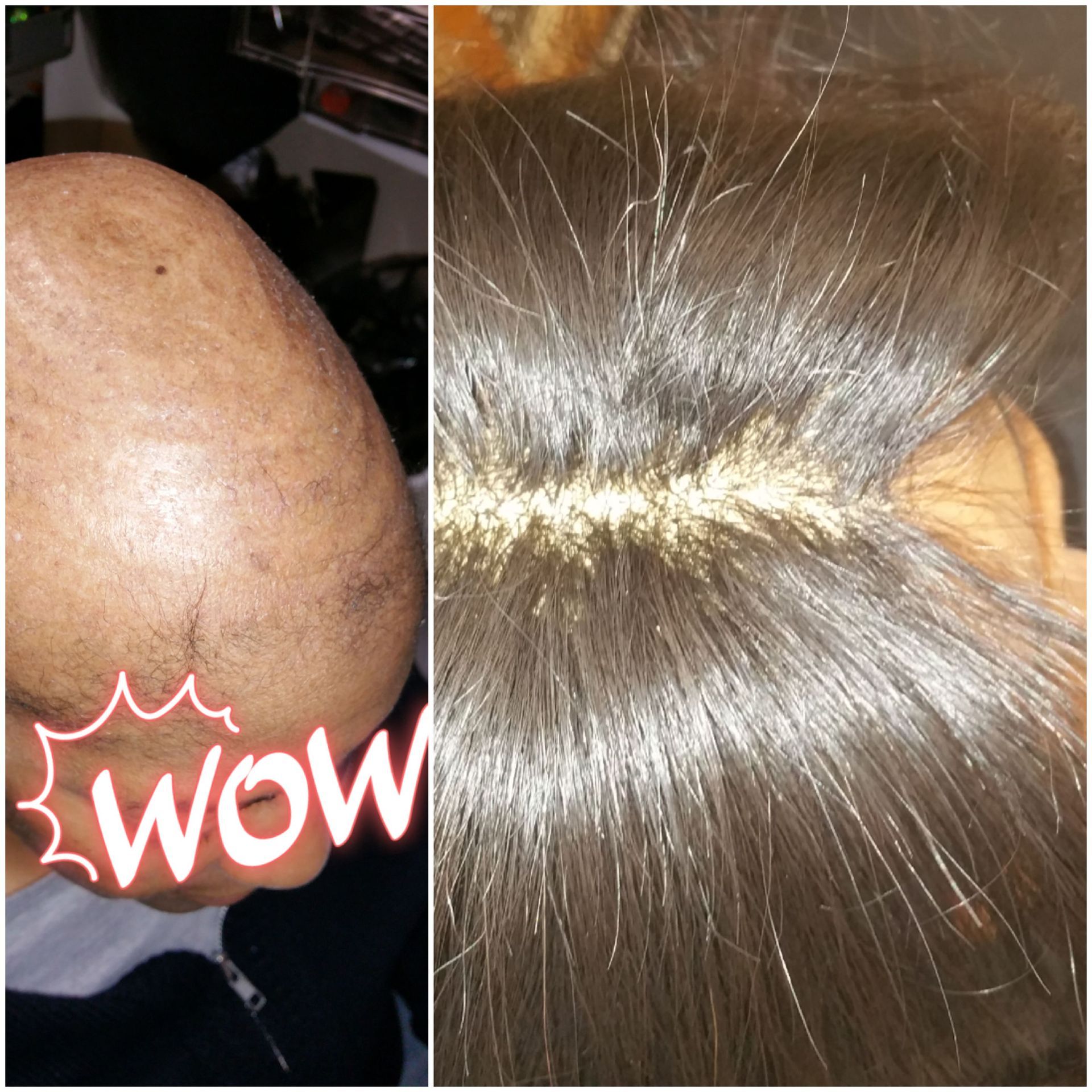 Nonsurgical Hair Replacement