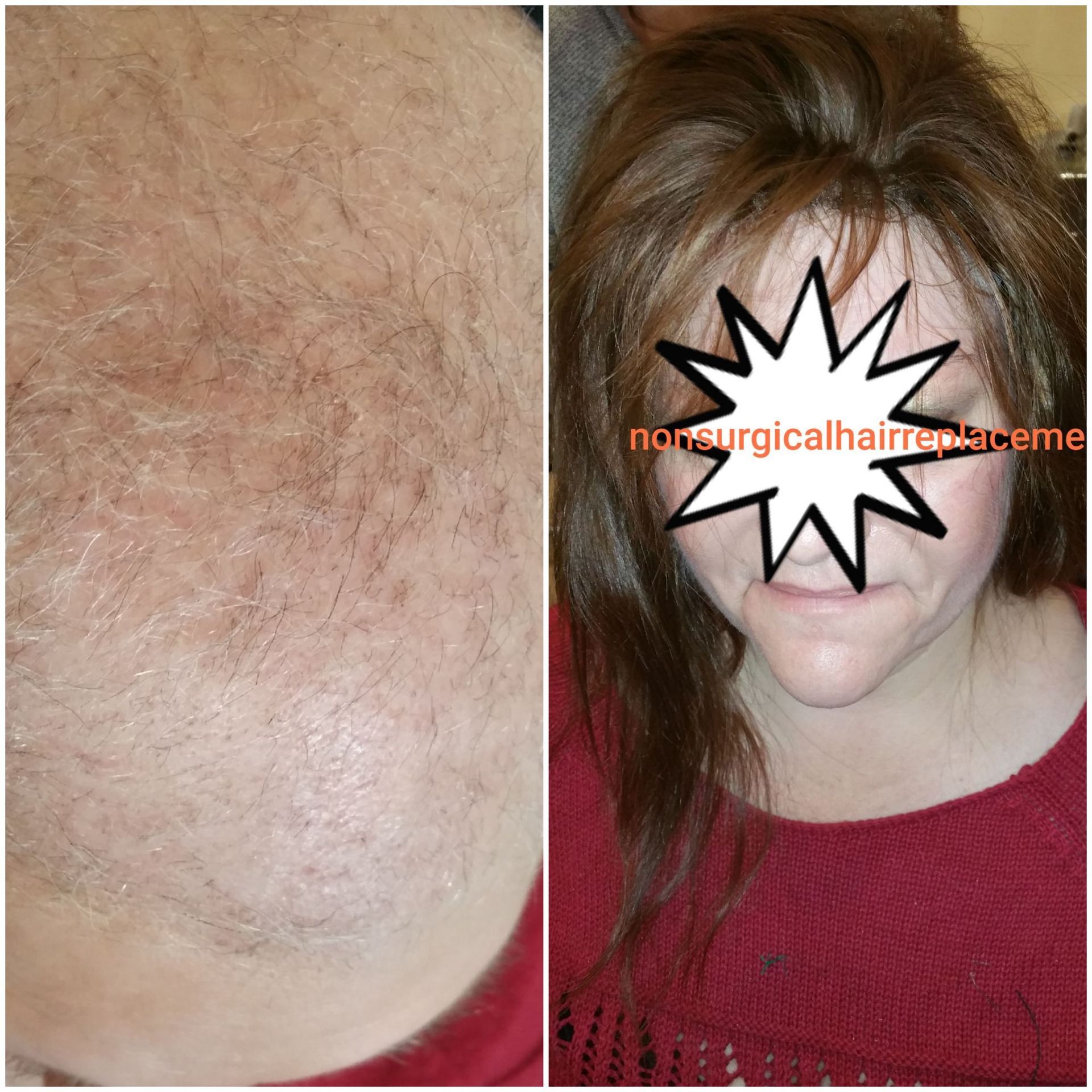 Nonsurgical Hair Replacement