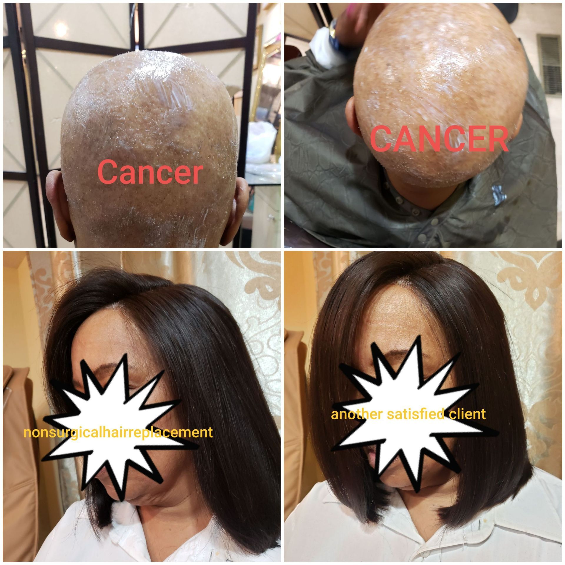 Nonsurgical Hair Replacement