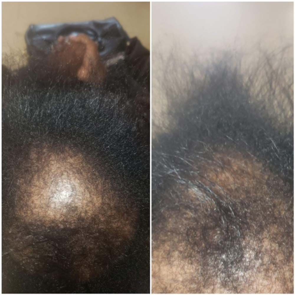 Hair Growth Results