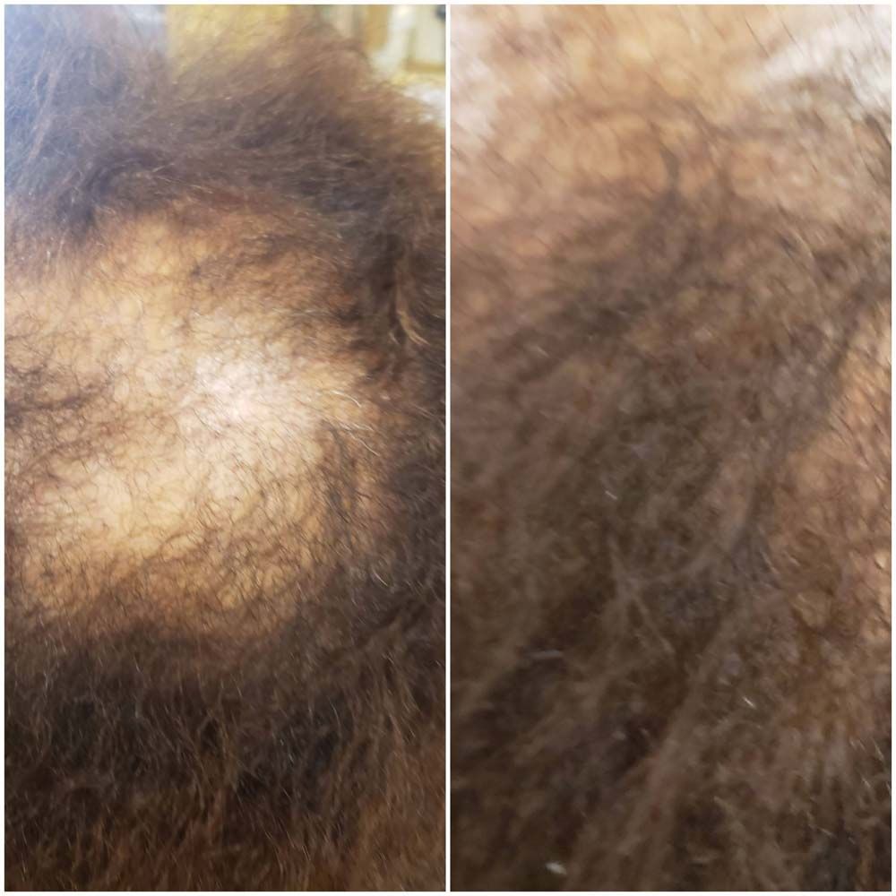 Hair Growth Results