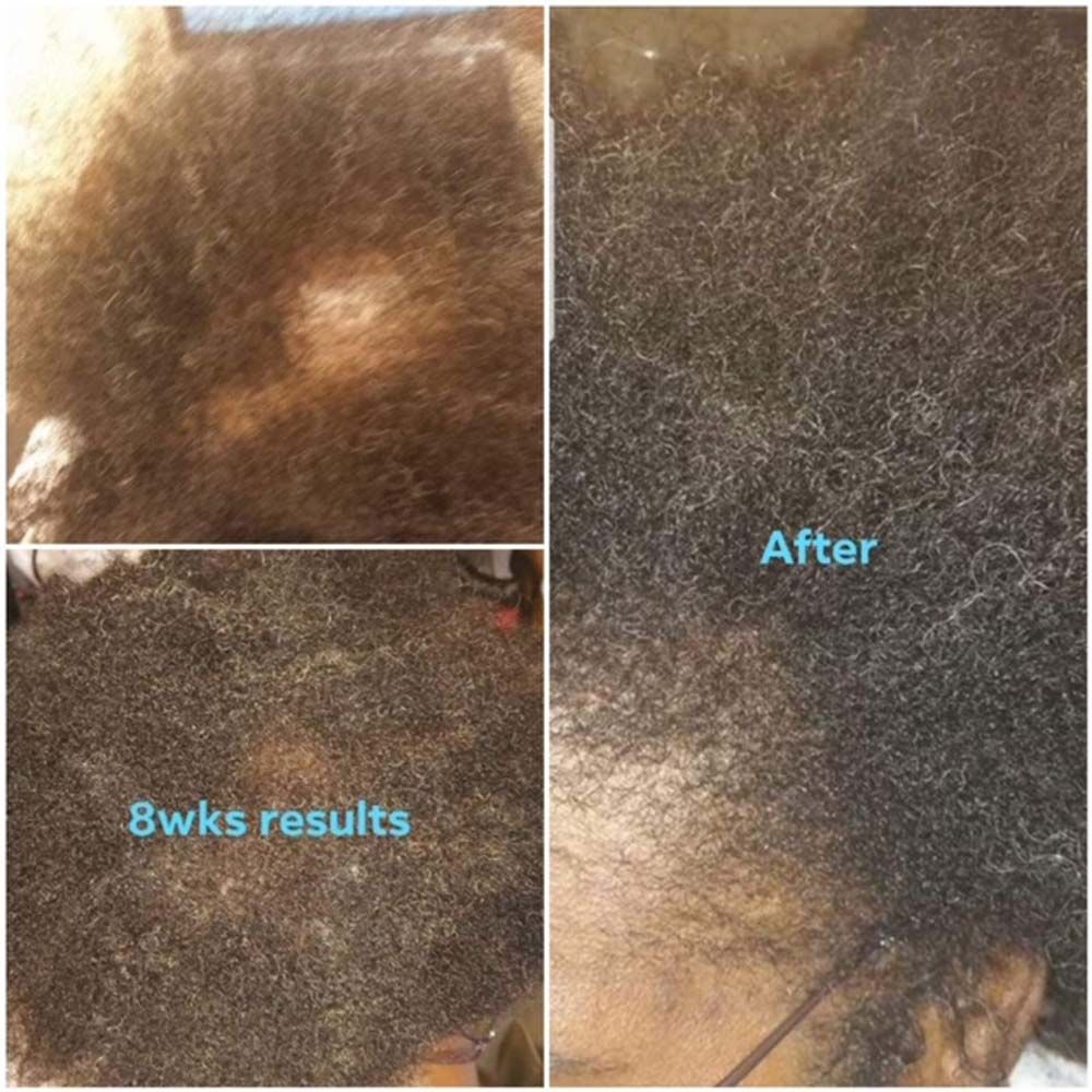 Hair Growth Results