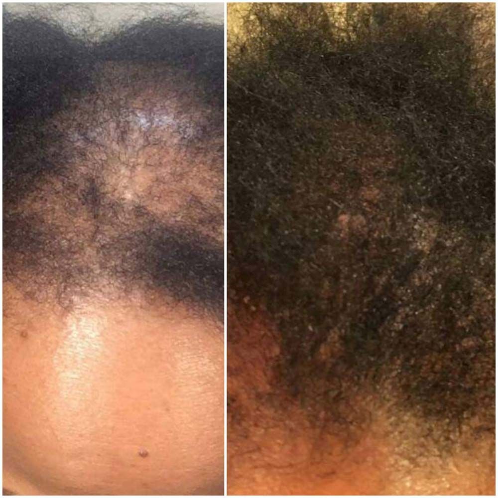Hair Growth Results