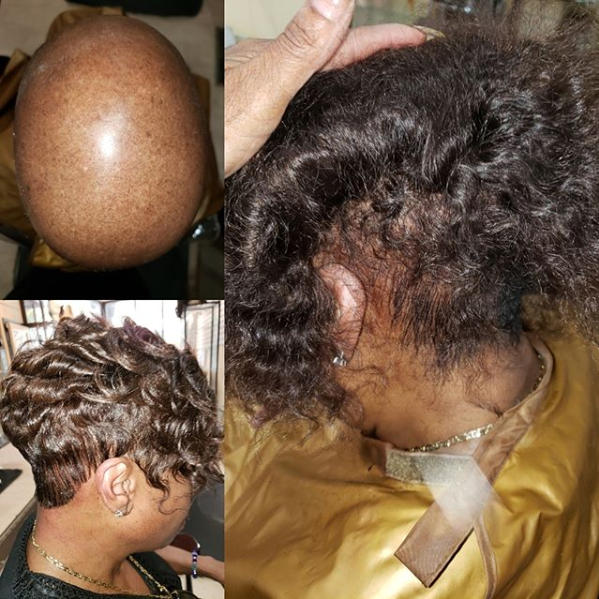 Nonsurgical Hair Replacement