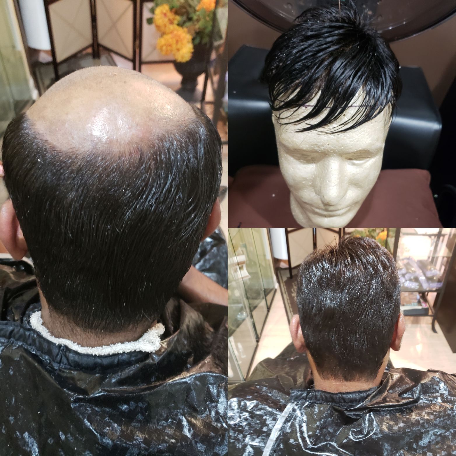 Nonsurgical Hair Replacement