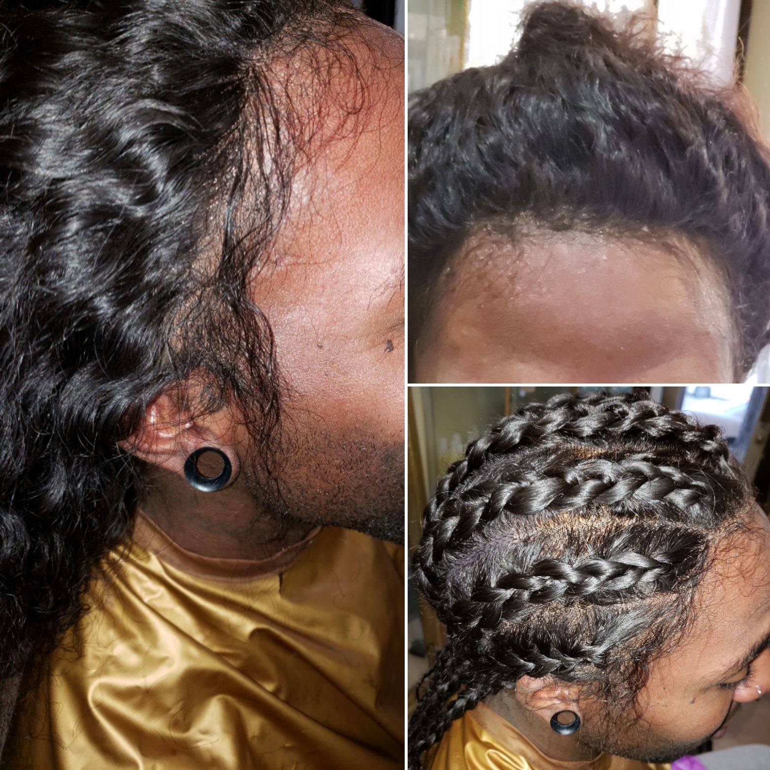Nonsurgical Hair Replacement