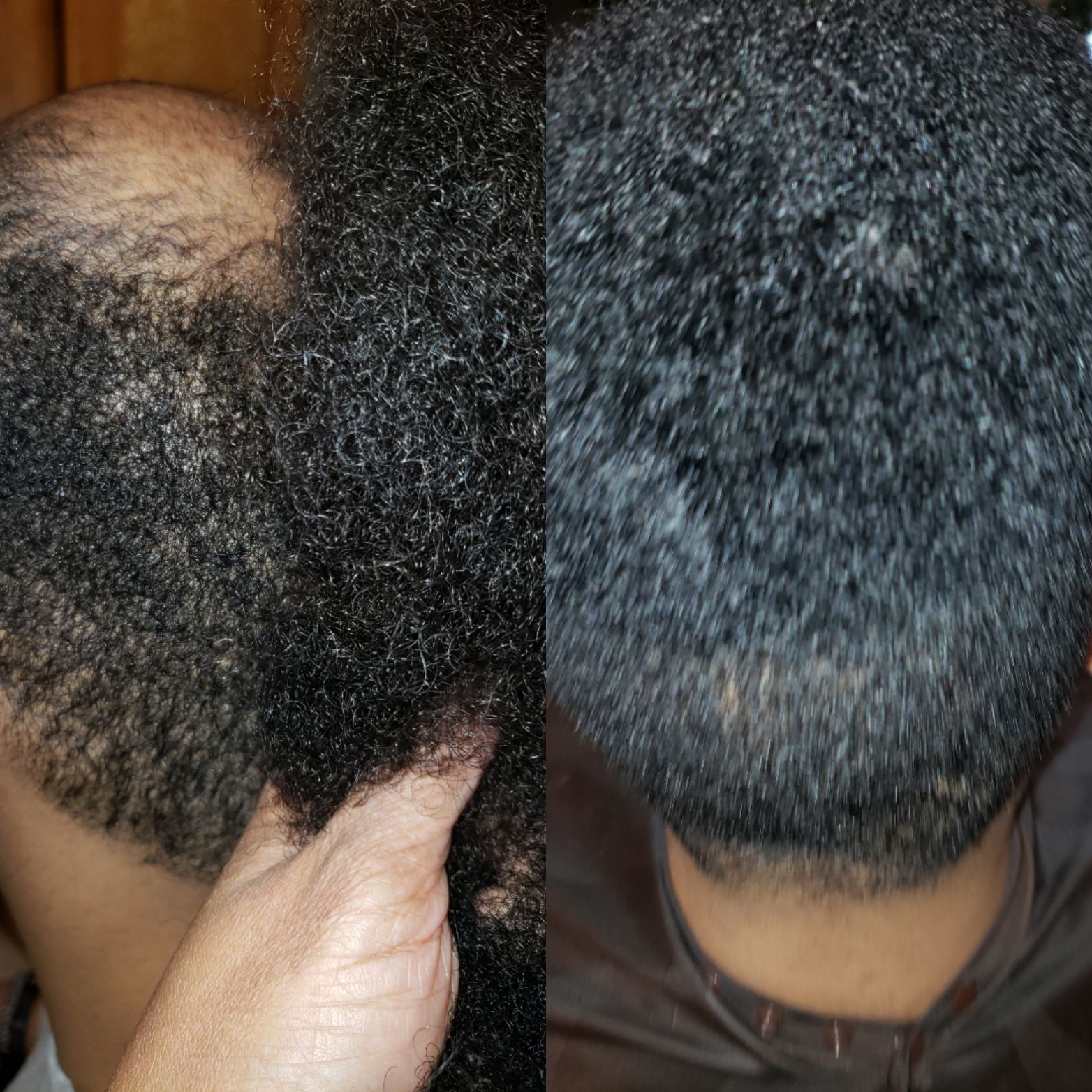 Nonsurgical Hair Replacement