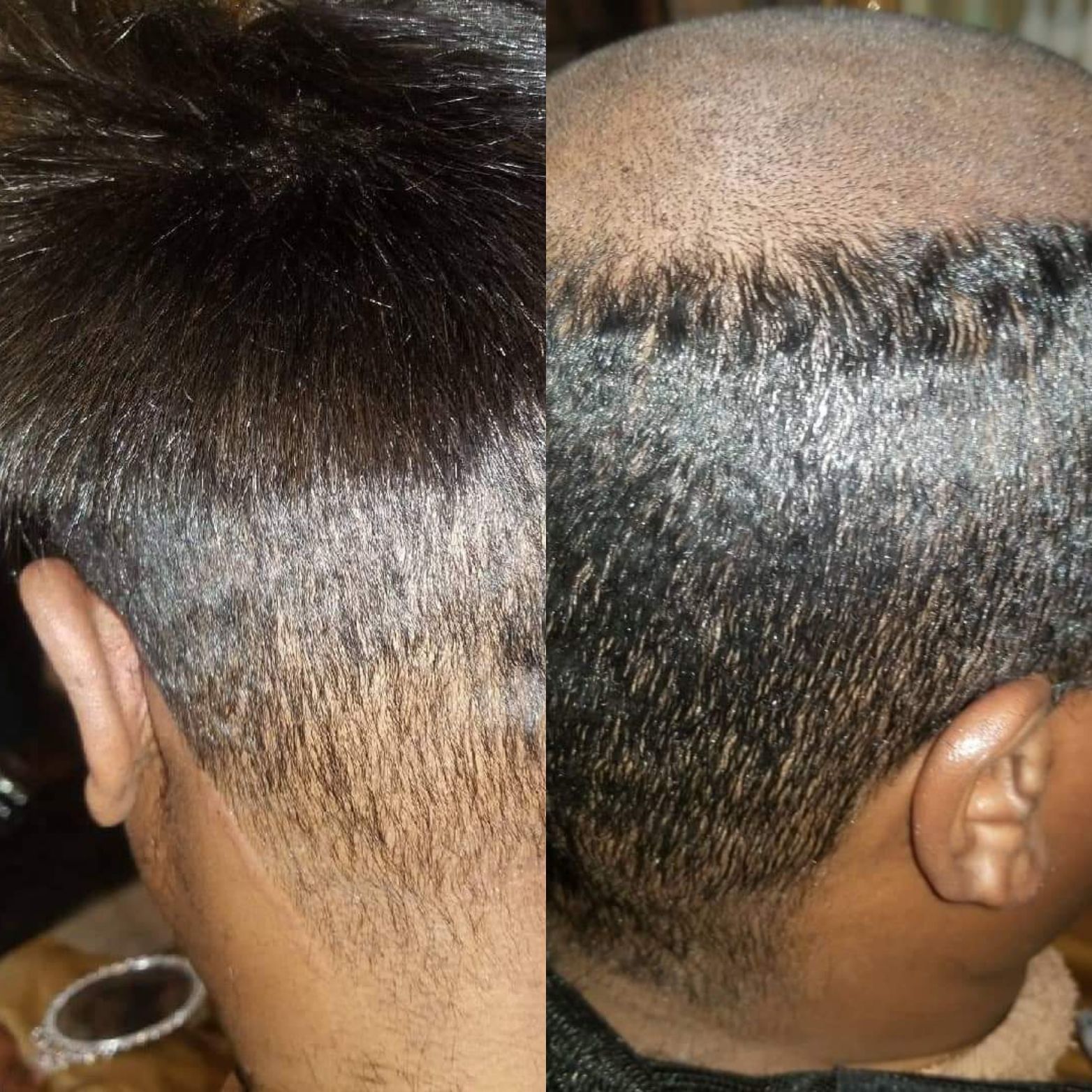 Nonsurgical Hair Replacement