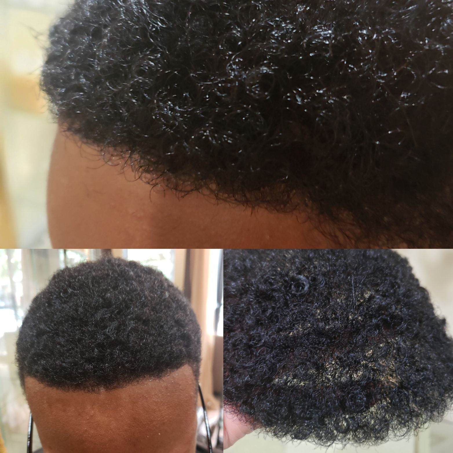 Nonsurgical Hair Replacement