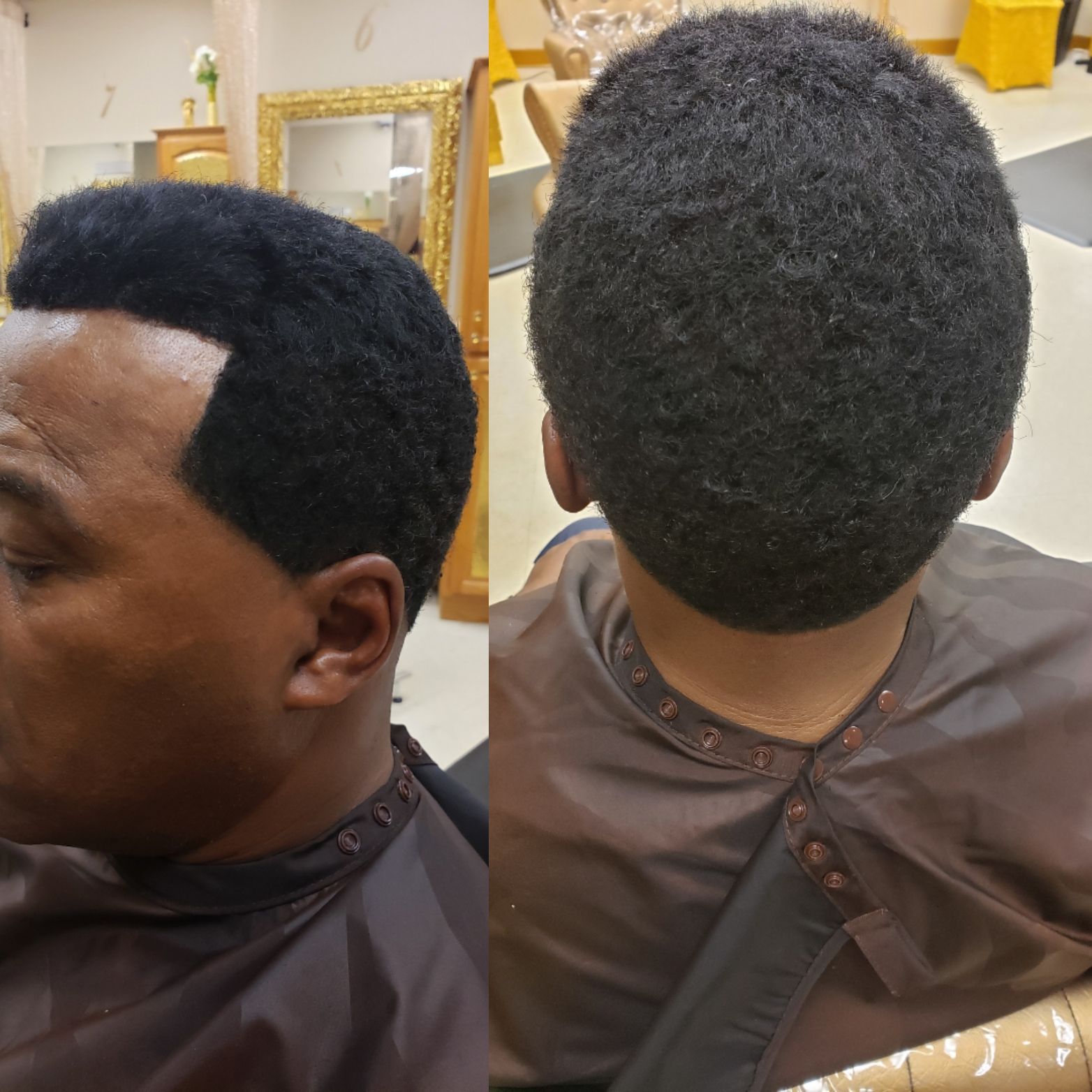 Nonsurgical Hair Replacement