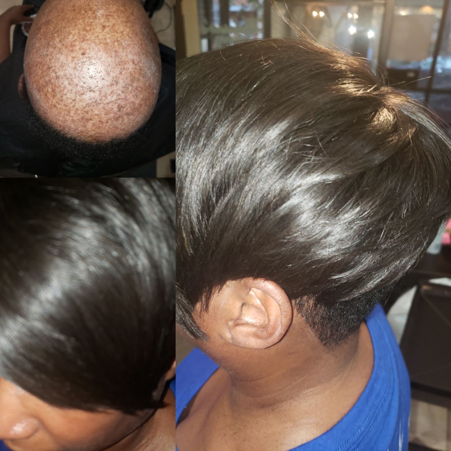 Nonsurgical Hair Replacement