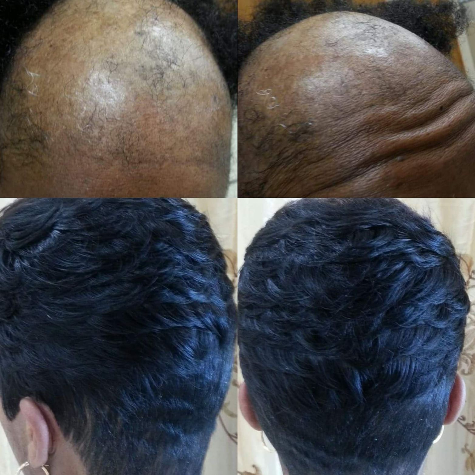 Nonsurgical Hair Replacement