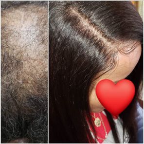 Non-surgical Hair Replacement