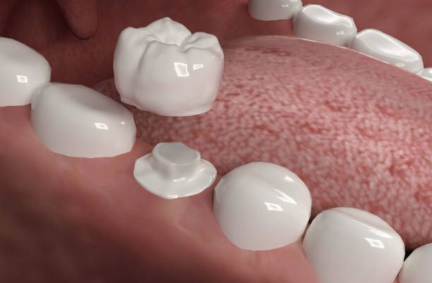 Dental Crown Concept — Henderson, NV — AQ Denture and Dental Implant Center