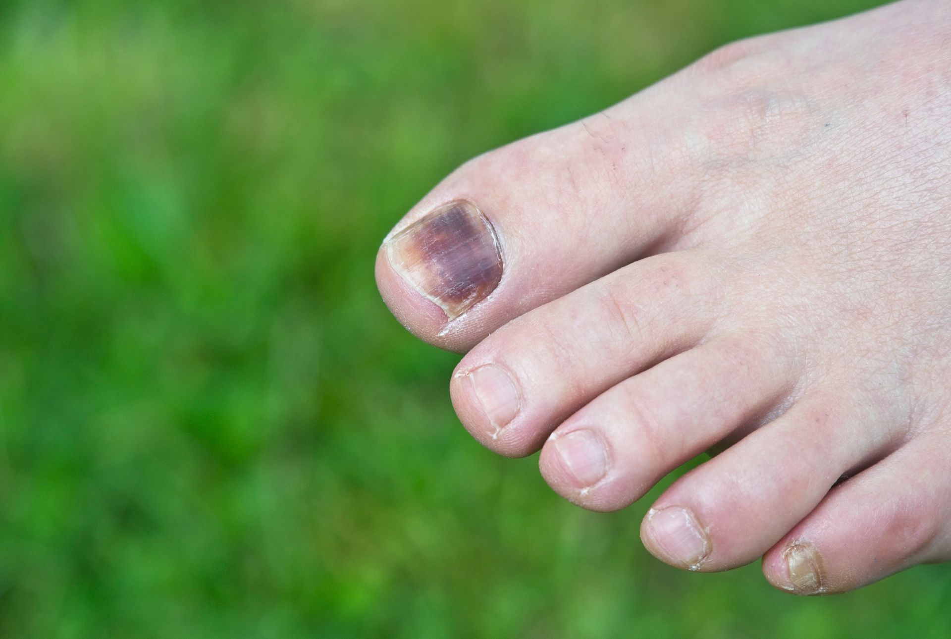 Toe with a bruised, dark purple toenail against a blurred green background.
