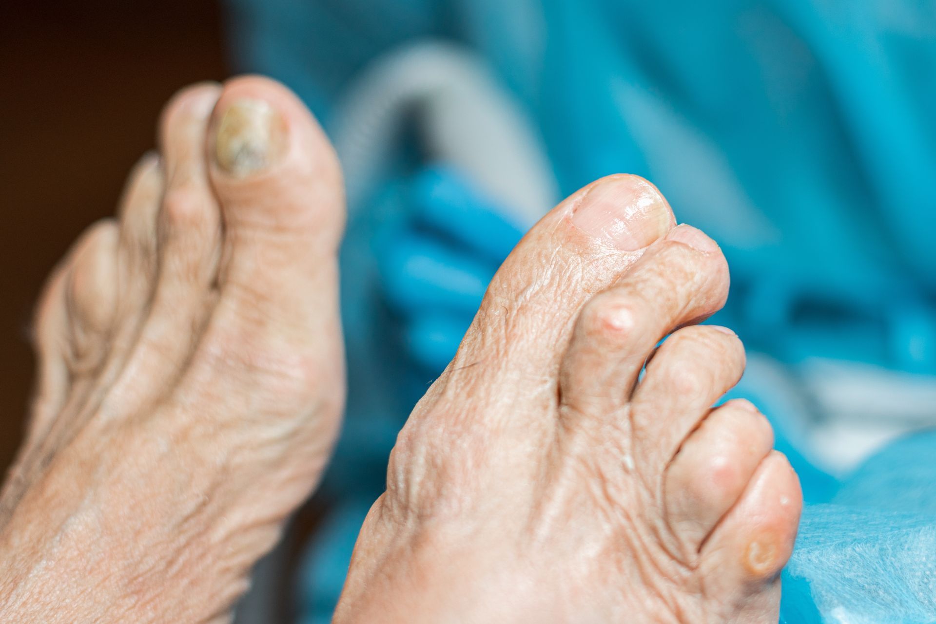 Close-up of elderly feet; a large toe has a discolored nail, other toes have noticeable bunions.