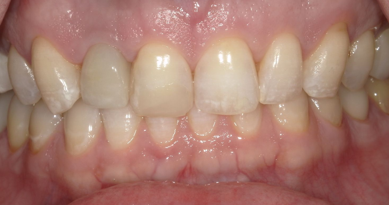 A close up of a person 's teeth with a broken tooth.