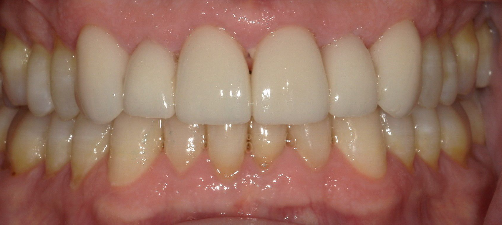A close up of a person 's teeth with porcelain crowns.