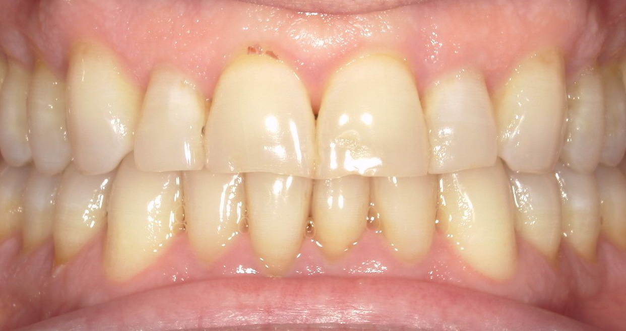 A close up of a person 's teeth with a broken tooth.