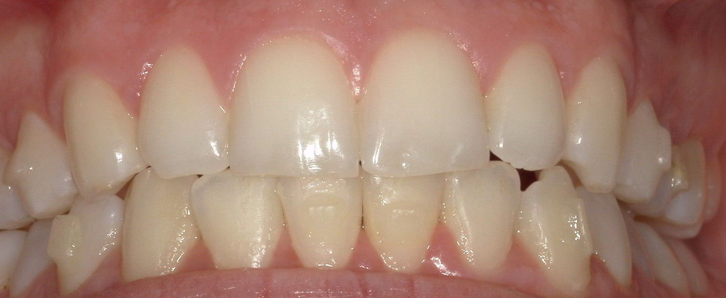 A close up of a person 's teeth with porcelain crowns.