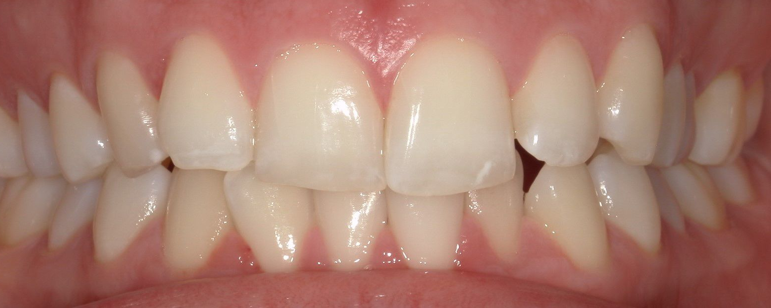 A close up of a person 's teeth with a broken tooth.