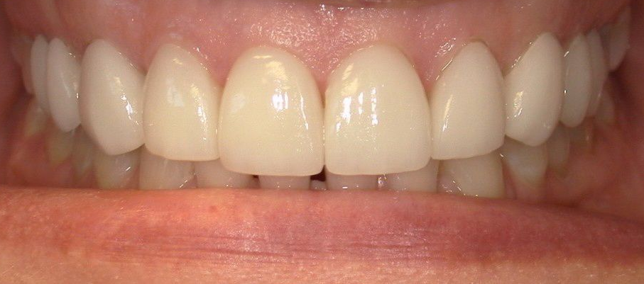 A close up of a person 's teeth with porcelain crowns.