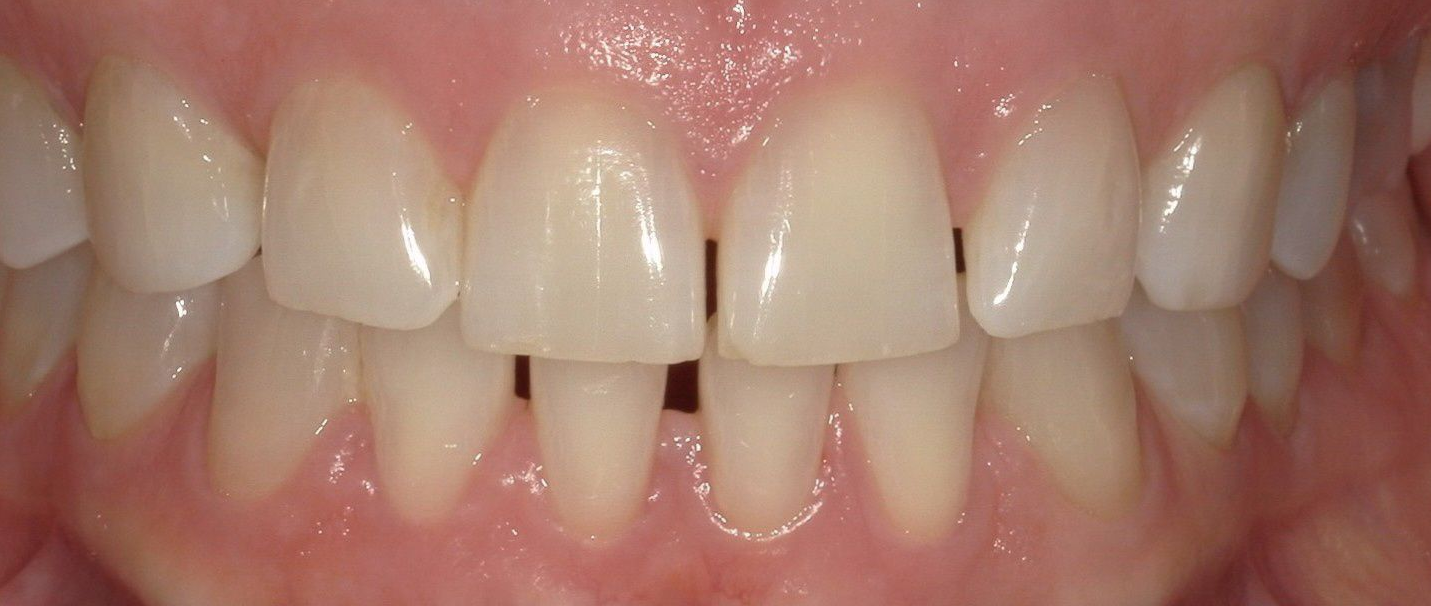 A close up of a person 's teeth with a broken tooth.