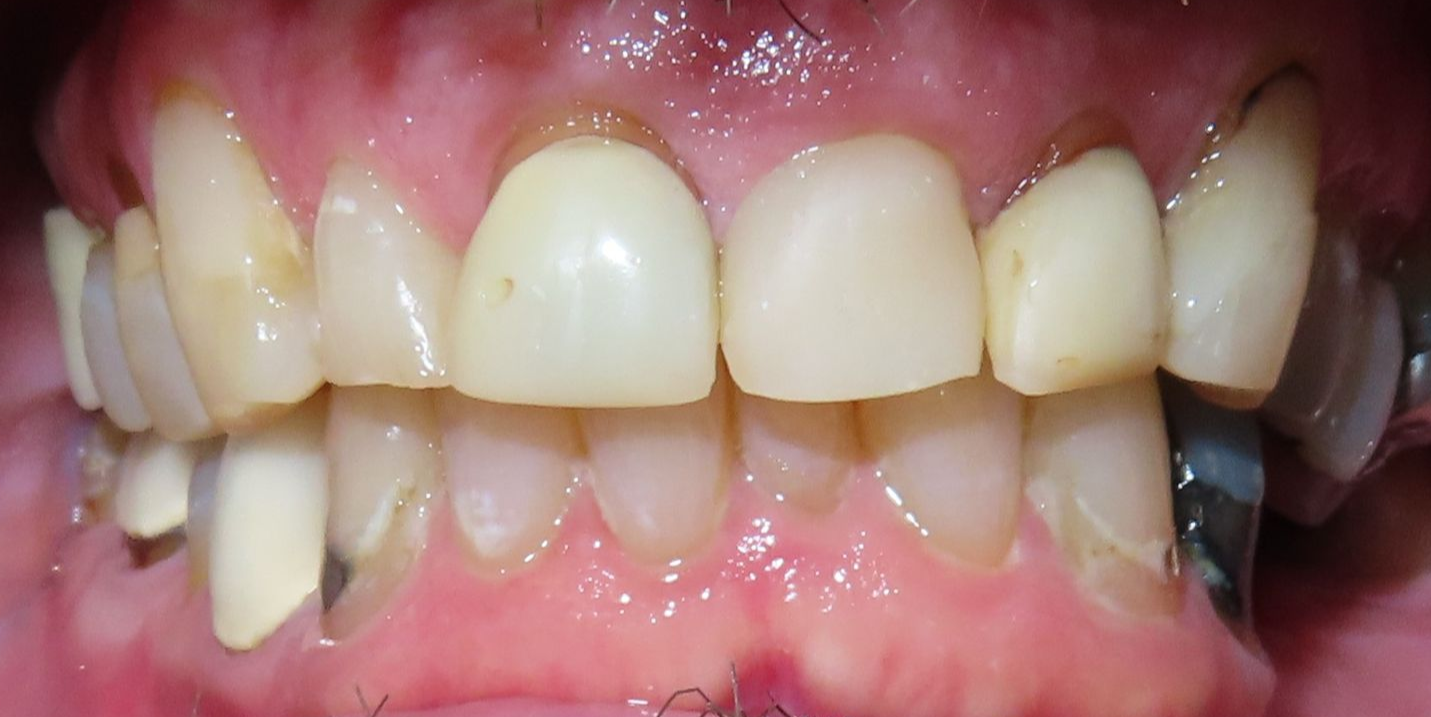 A close up of a person 's teeth with a broken tooth.