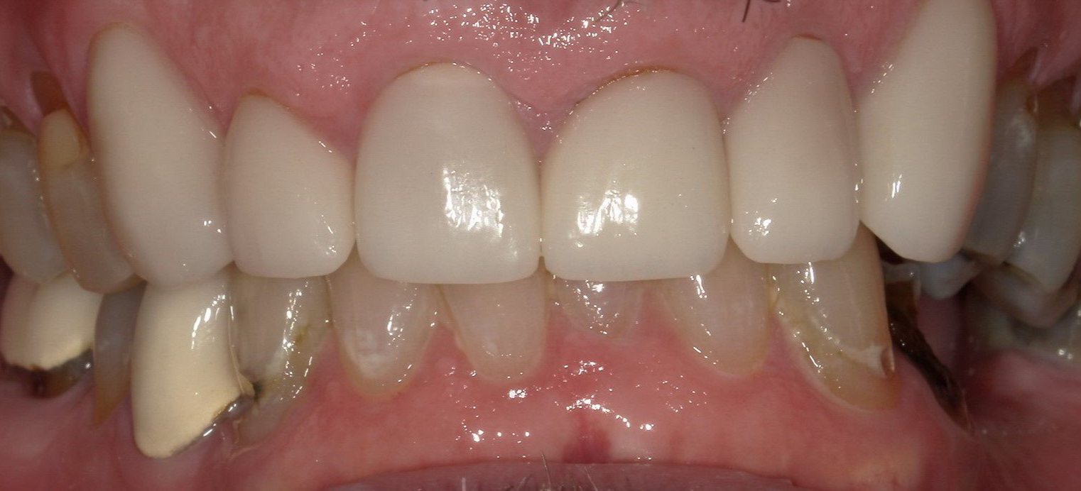 A close up of a person 's teeth with porcelain crowns.