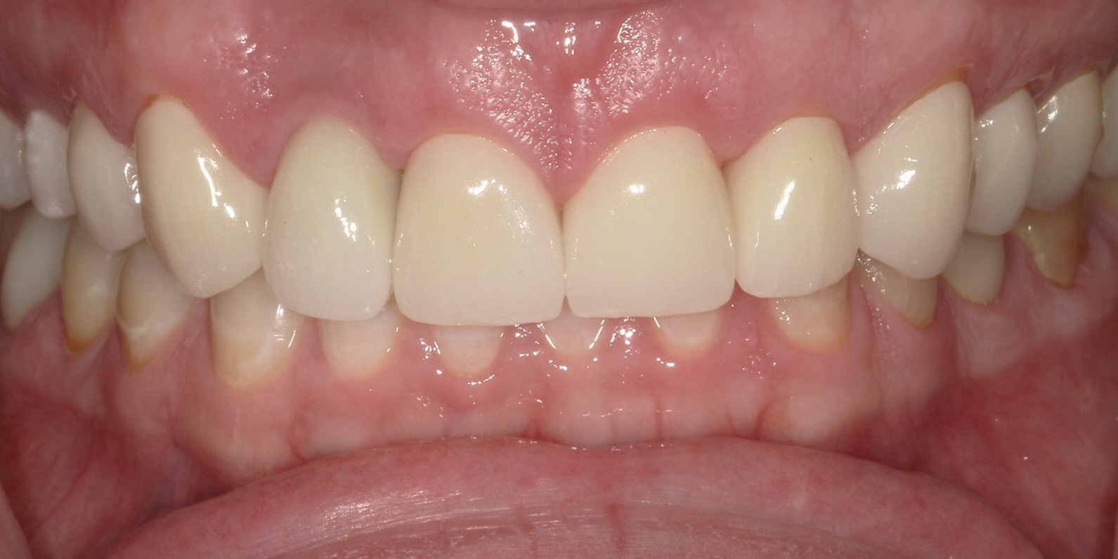 A close up of a person 's teeth with porcelain crowns.