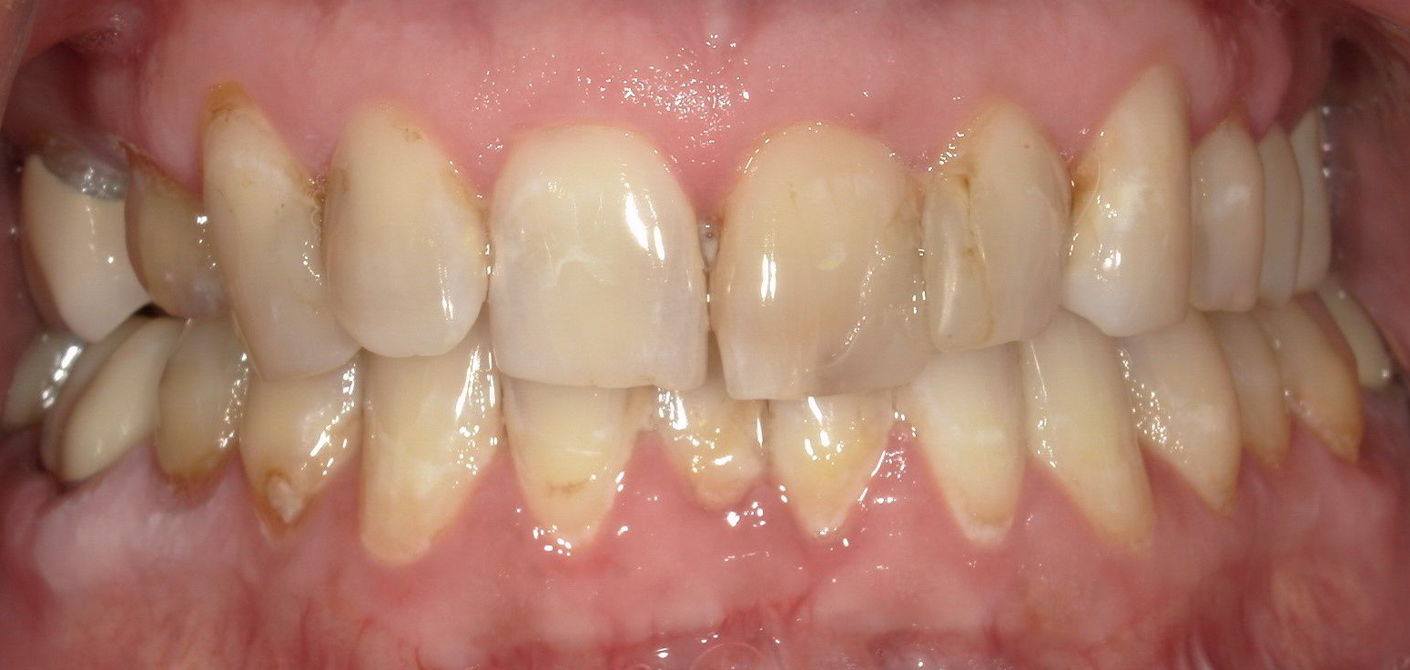 A close up of a person 's teeth with a broken tooth.