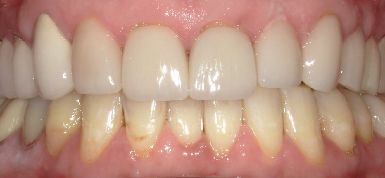 A close up of a person 's teeth with porcelain crowns.