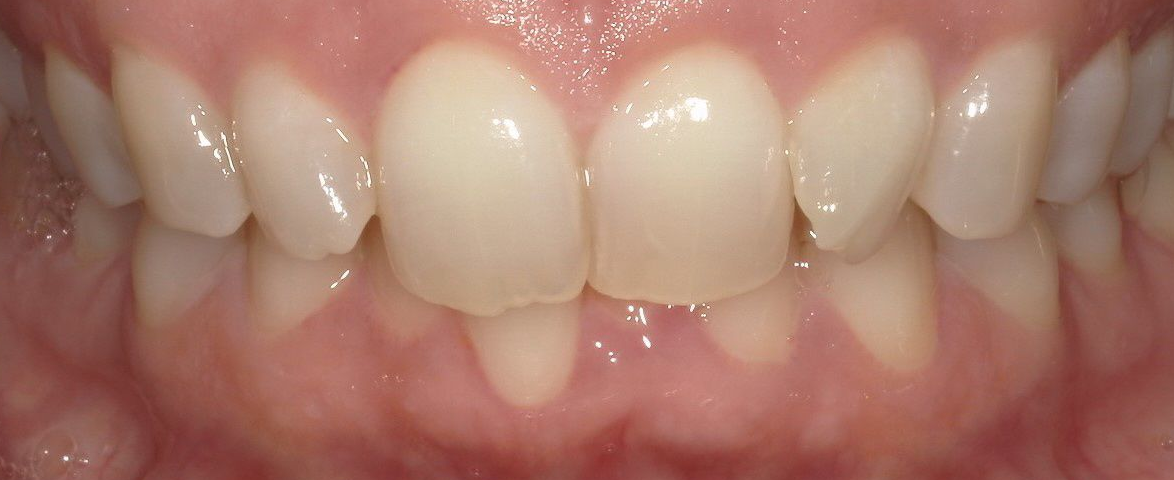 A close up of a person 's teeth with a broken tooth.