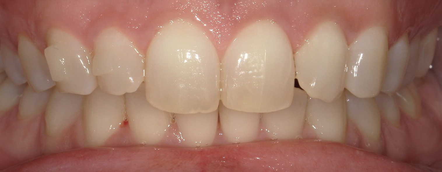 A close up of a person 's teeth with porcelain crowns.